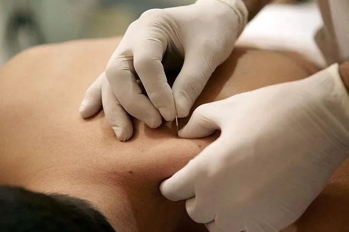 Närbild av nålsättning vid behandling med Dry Needling